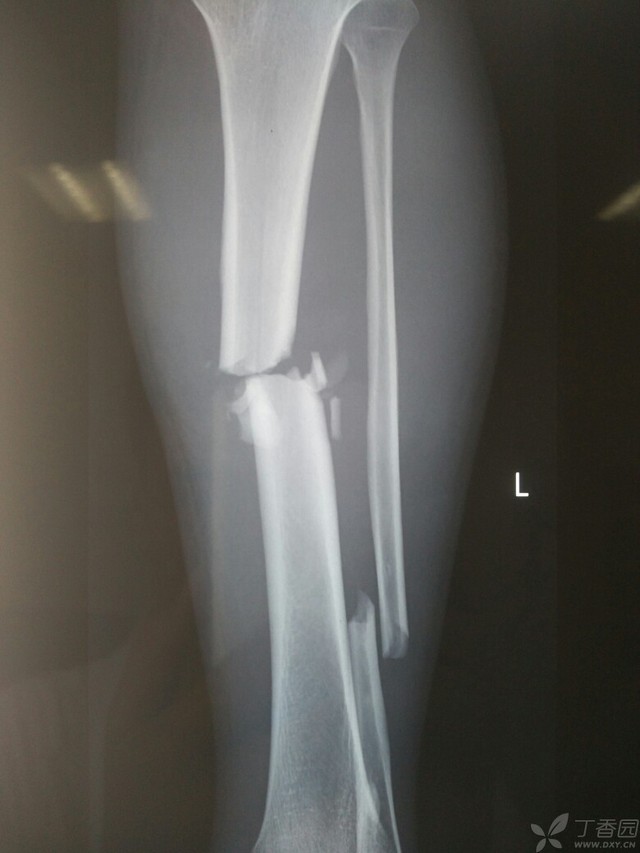 科技重塑脛腓骨骨折康復(fù)之旅，引領(lǐng)未來體驗(yàn)新篇章