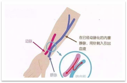 靜脈瘺最新資訊，掌握最前沿的健康信息